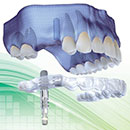 インプラント埋入ガイド